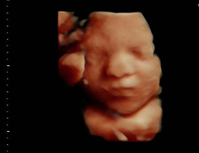 3D ultrasound image at 31 weeks